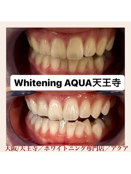 アクア 天王寺店(AQUA)/セルフホワイトニング/天王寺