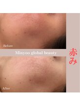ミニョ コリアンビューティー(Minyoo korean beauty)/症例写真/赤み