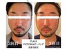 【男性限定】余分な皮脂を取り除き肌質を整えるハーブピーリング