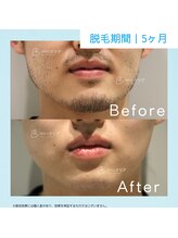 メンズクリア 松本店/【メンズクリア】お客様の施術例