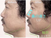 ラプリ 大宮店(Raplit)/隆鼻＋輪郭矯正40分20回