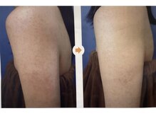 アルストロメリア(Alstroemeria)/腕脱毛