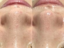 キアラ(CHIARA)/ハイドラフェイシャル