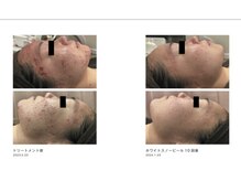 スイ 昭島店(Sui)/ホワイトスノーピール/シミ/美白