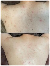 リコ(Lico)/背中ニキビ