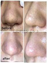 ミント/1度は試して◎毛穴洗浄マスト！