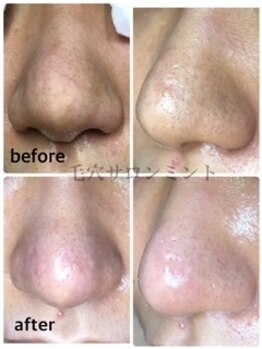 ミント/1度は試して◎毛穴洗浄マスト！