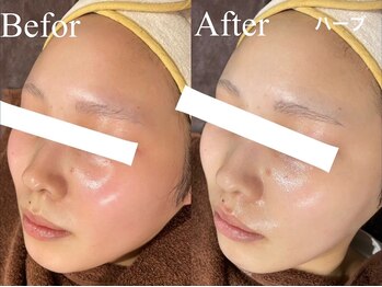 レア 姫路店(le'a)/ハーブピーリングで透明感UP