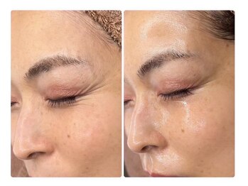 ホワイトアクア 京橋店(WHITE AQUA)/ララピールで目尻のシワ改善