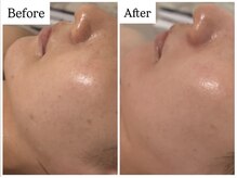 ベル 恵比寿(Belle)/REVI陶肌ハーブピーリング