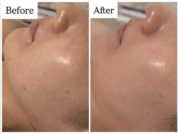 ベル 恵比寿(Belle)/REVI陶肌ハーブピーリング