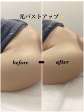 メディカルサロンドオフ 堺東店(medical salon de off)/光バストアップメニュー♪前後