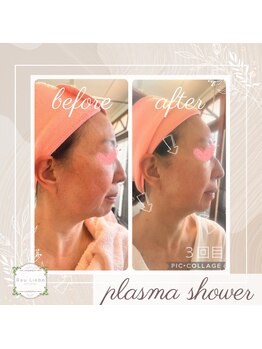 ラウリーベ(Rau Liebe)/プラズマ3回/40代