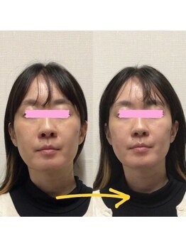 アレイズ/小顔矯正コース