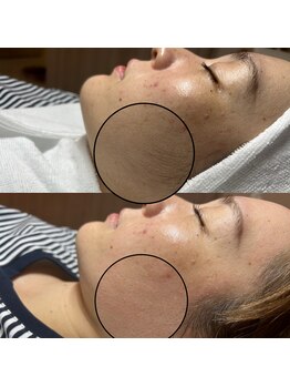 エルミュ(Elmu)/韓国美肌ワックス脱毛