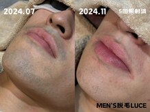 ルーチェ/【ヒゲ脱毛】パートナーから好評