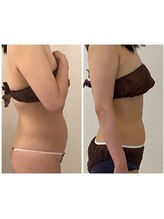 美人バスト 本厚木店/【痩身】症例☆