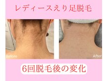 グロワール(gloire)/レディースえり足BeforeAfter