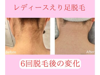 グロワール(gloire)/レディースえり足BeforeAfter