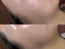 ゴールデンエイジ 吉祥寺(GOLDEN AGE)/ワックス脱毛 : 施術