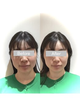 ワカヤマ 小顔(Wakayama)/★Before・After★