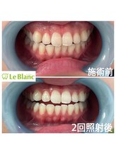 ルブラン 奈良店(Le Blanc)/白さ体感できます！！
