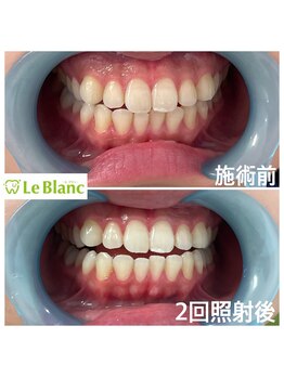 ルブラン 奈良店(Le Blanc)/白さ体感できます!!