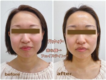 エステシオン(ESTESiON)/小顔×美肌効果