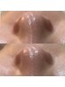 【リフトUP&鼻の黒ずみ除去】毛穴洗浄（ハイドラ）＋小顔リフト＋美容液導入
