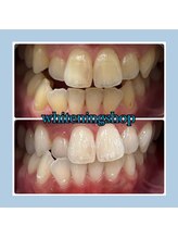 ホワイトニングショップ 堺東店/【ビフォーアフター】10回