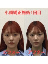 オズ六本木/六本木小顔矯正(造顔)施術1回