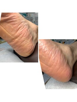長岡巻き爪矯正センター/50代男性ビフォーアフター