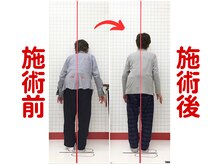 ほねつぎ須屋鍼灸接骨院/姿勢矯正１
