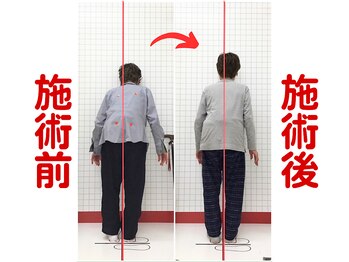 ほねつぎ須屋鍼灸接骨院/姿勢矯正1