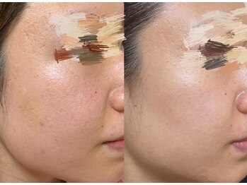 エトワール 横浜馬車道店(ETOILE)/肌質・たるみ改善|ほうれい線