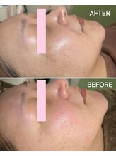 ギルドハナレ(GUILD HANARE)/"プラズマシャワー"