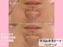 エンクリニカルラボ 京都駅前店(E&N CLINICAL LABO)/WiQo水光ピールパッケージ