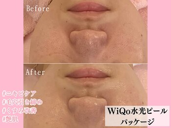 エンクリニカルラボ 京都駅前店(E&N CLINICAL LABO)/WiQo水光ピールパッケージ