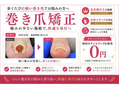 巻き爪矯正ラボ 水戸の写真