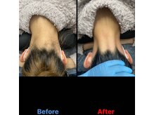 アンフィニ(Infini)/人気のうなじ脱毛の効果★