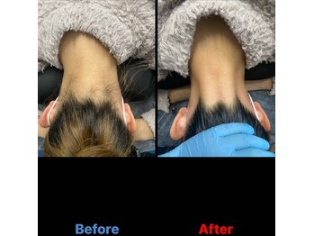 アンフィニ(Infini)/人気のうなじ脱毛の効果★