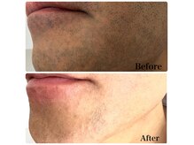 ジョリエストワ(Joliesse toi)の雰囲気（ヒゲ脱毛Before→After清潔感もアップし、若々しい見た目に！！）