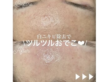 ミラーヴ(MERAVE)/施術は鼻だけじゃない！