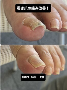 巻き爪じゅん 千葉駅前店/船橋市で巻き爪の痛みを改善！