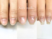 アーティネイルズ(Aaty Nails)/【深爪矯正】ハンド