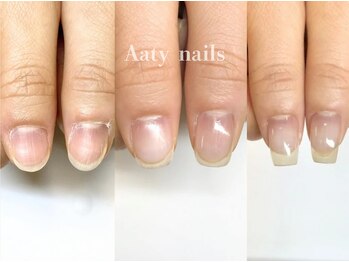 【深爪矯正】ハンド