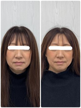 ラフテル鍼灸整骨院/40代に人気の美容鍼×小顔矯正♪