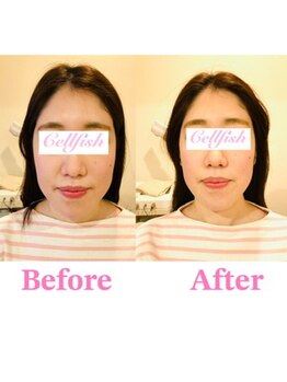 セルフィッシュ(Cellfish)/小顔×美容整体