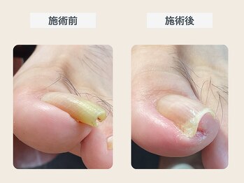 ルポ 伊勢/巻き爪ケア