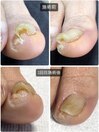 ~巻き爪・陥入爪補正~